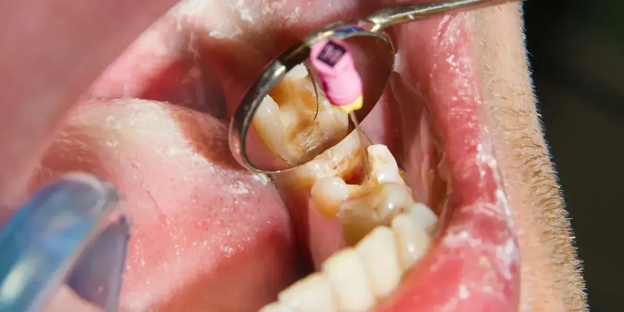 Zgorzel zęba to martwica miazgi. Widoczny ząb w lustrze dentystycznym, z narzędziem w kanale korzeniowym.