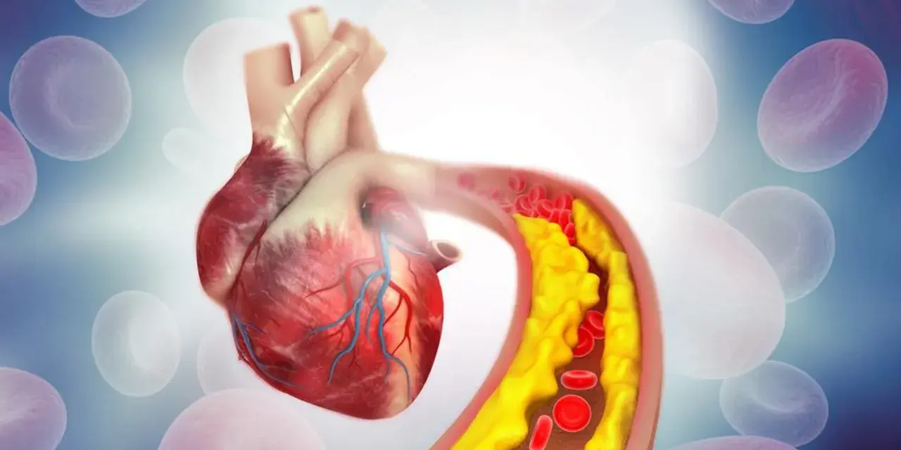 Serce i tętnica z miażdżycą. Żółte złogi cholesterol nie-hdl zwężają naczynie, utrudniając przepływ krwi.