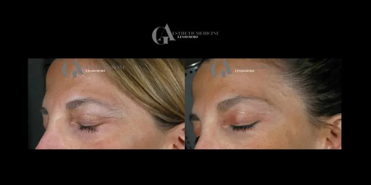Confronto botox viso prima e dopo: rughe attenuate sulla fronte e contorno occhi più disteso.
