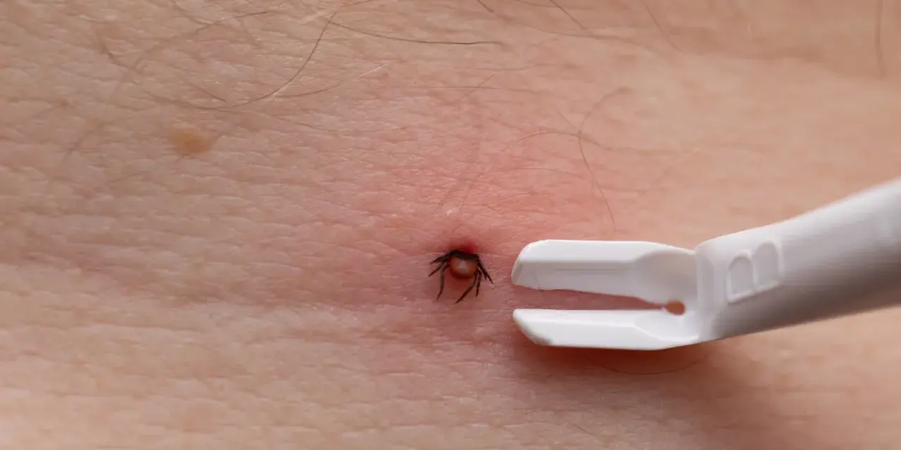 Urwany kleszcz w skórze? Rozpoznaj resztki i działaj krok po kroku