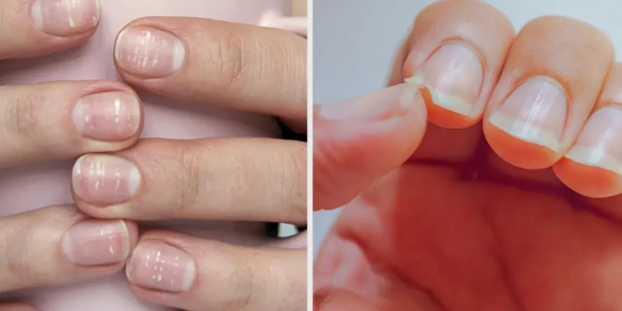 Ongles cassants, striés, manquent de nutriments essentiels. Une main montre des ongles fragiles, l'autre une écaille qui se détache.
