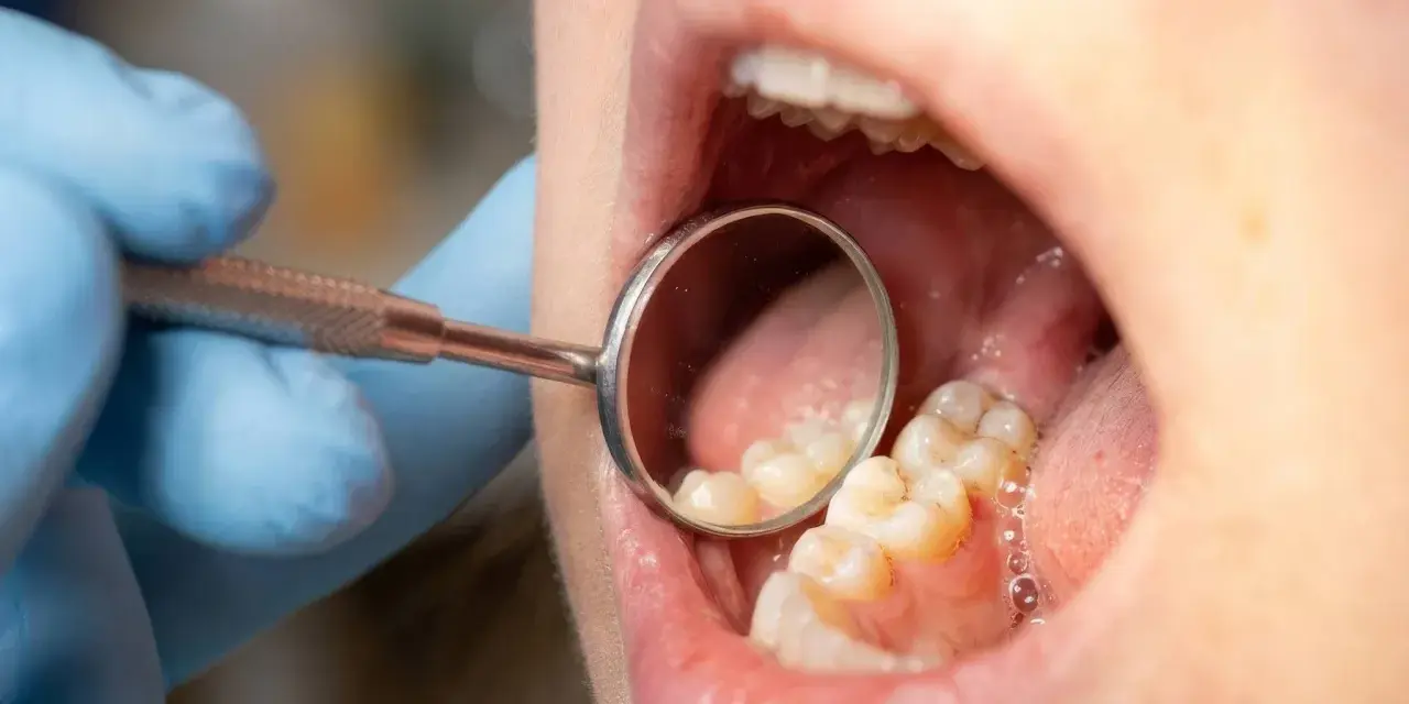 Dentysta bada zęby, szukając próchnicy między zębami.