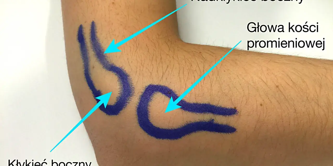 Zaznaczone na niebiesko struktury anatomiczne łokcia: nadkłykieć boczny kości ramiennej, głowa kości promieniowej i kłykieć boczny kości ramiennej.