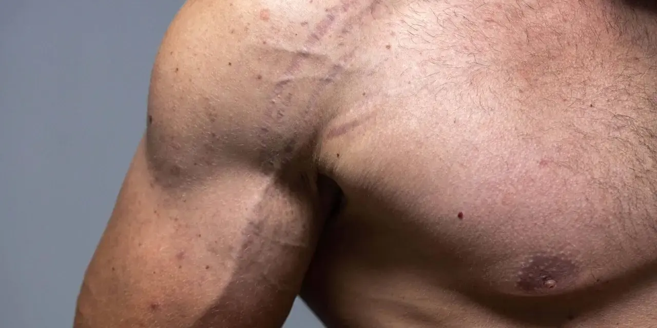 Widoczne rozstępy na bicepsie i ramieniu mężczyzny, świadectwo intensywnego treningu lub zmian wagi.