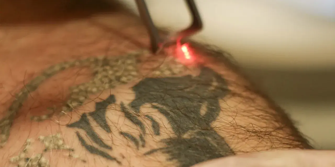 Laser usuwanie tatuażu. Czerwony promień lasera rozjaśnia ciemny wzór na skórze, rozpoczynając proces usuwania tatuażu.