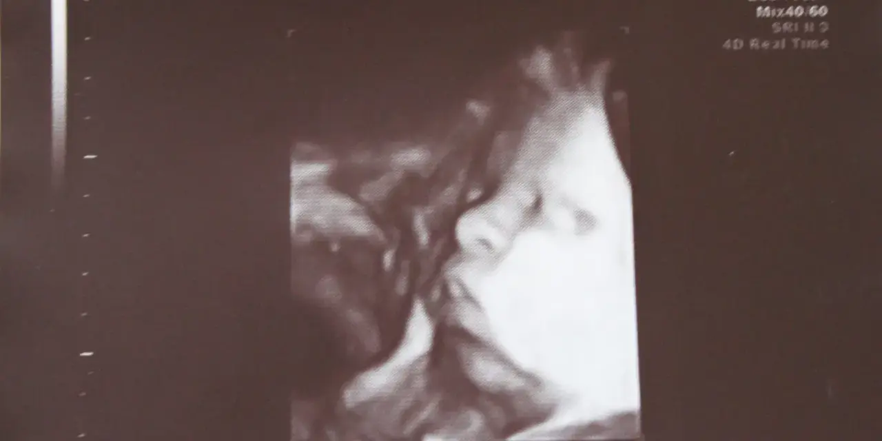 USG 3D pokazuje twarz dziecka w 32 tygodniu ciąży, który to miesiąc. Widać nos i usta.