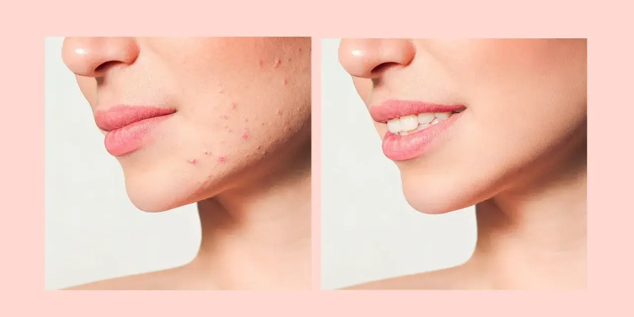 Prima e dopo: pelle con imperfezioni e poi pelle liscia e luminosa, mostrando la trasformazione dopo il processo di skin purging.