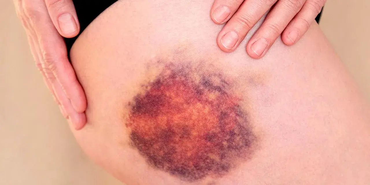 Große, dunkle blaue Flecken auf der Haut des Oberschenkels, die von einer Hand berührt werden.