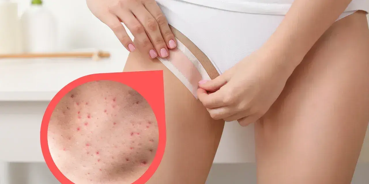 Zbliżenie na skórę z krostami po goleniu bikini. Dowiedz się, co na krosty po goleniu bikini pomoże.