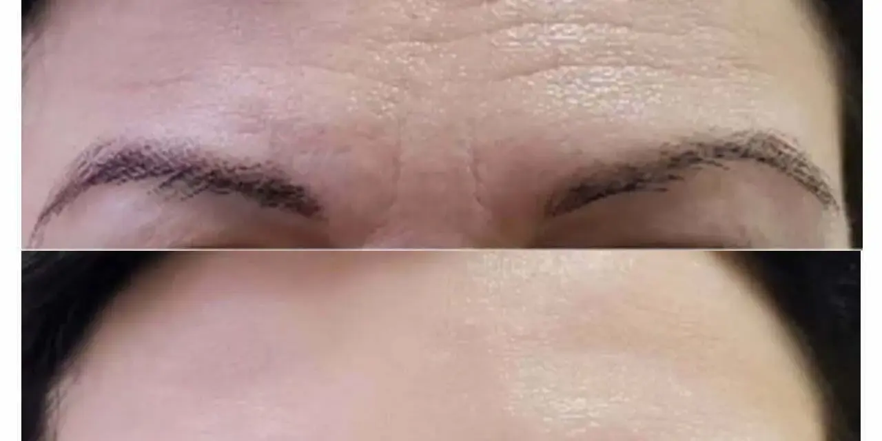 Comparación de frente: arriba, arrugas marcadas; abajo, piel lisa y rejuvenecida.