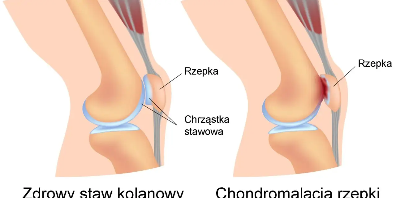 Porównanie zdrowego stawu kolanowego z chondromalacją rzepki, gdzie chrząstka stawowa jest uszkodzona.