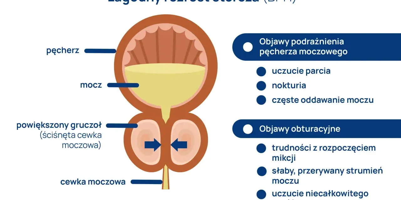 Ilustracja pokazuje łagodny rozrost stercza (BPH) i jego objawy. Prostata, czyli gruczoł krokowy, powiększa się, uciskając cewkę moczową.