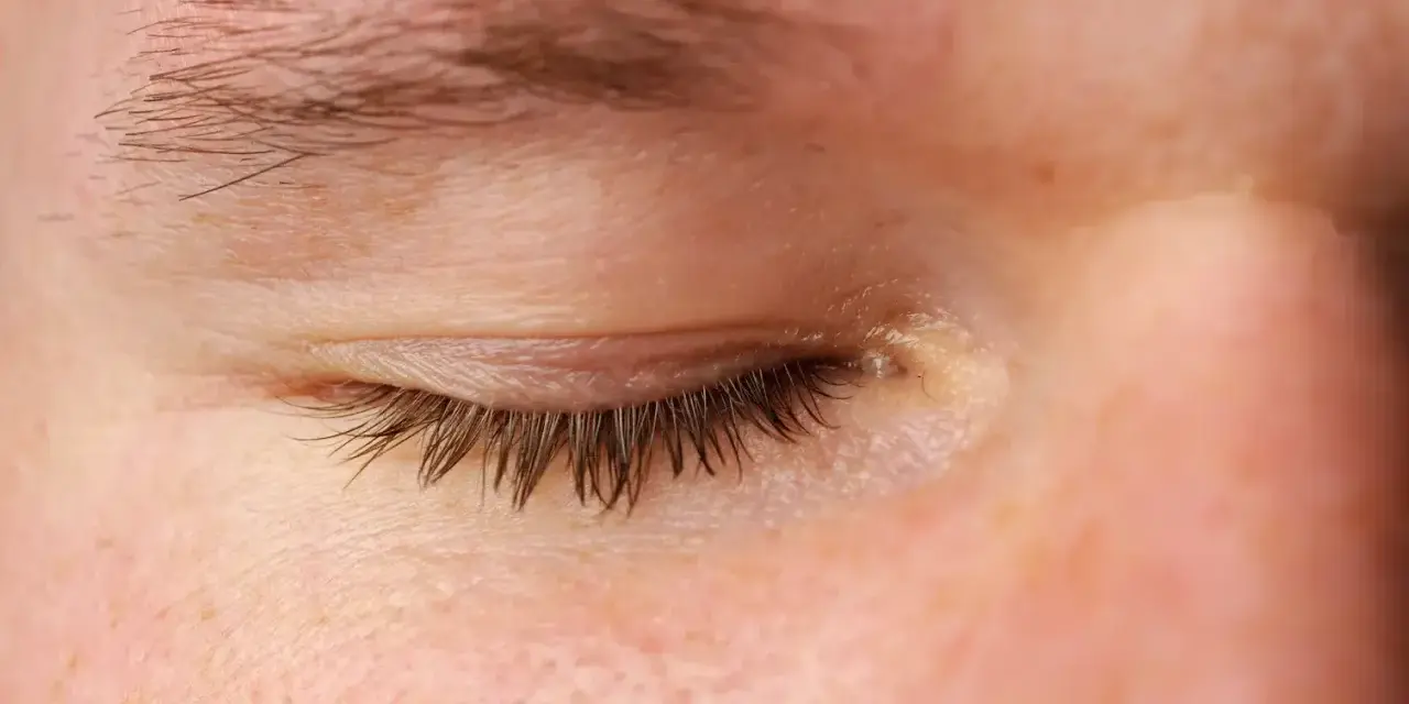 Ojo cerrado con pestañas oscuras y piel con leve grasa en los párpados.