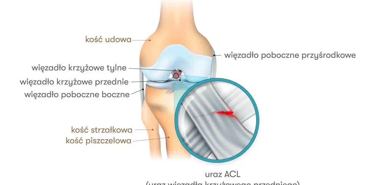 Anatomia kolana z zaznaczonym urazem ACL (przedniego więzadła krzyżowego). Widoczny pęknięty włókna więzadła.