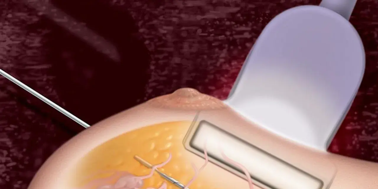 Ilustracja przedstawia biopsję mammotomiczną piersi z użyciem sondy ultradźwiękowej i igły.