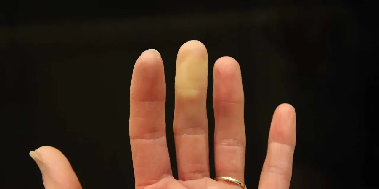 En hand med en gulnad fingertopp, som om den fryser. Kan vara ett tecken på kaloriunderskott.