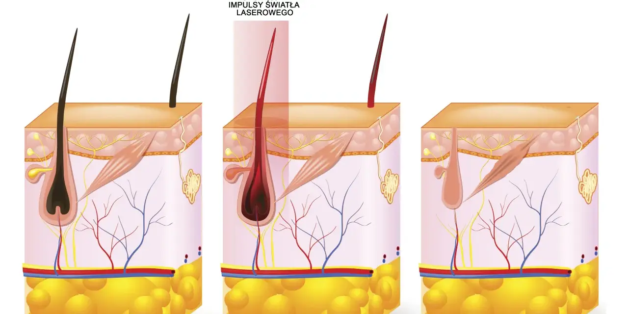 Ilustracja pokazuje laserowe usuwanie wąsika: przed zabiegiem, ekspozycję na laser i efekt po.