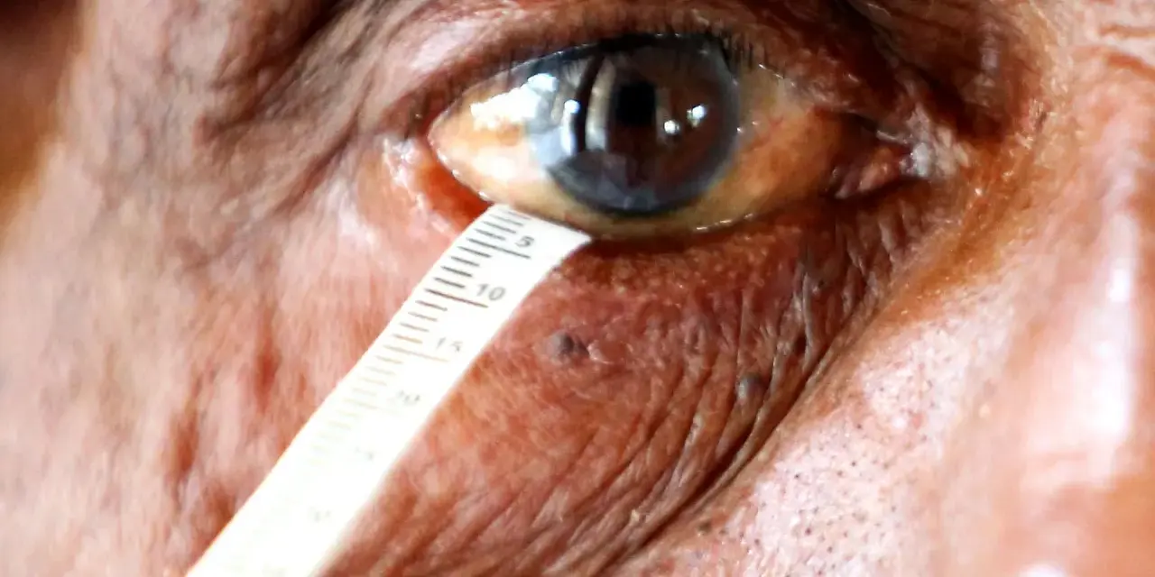Misurazione della lacrimazione per un test occhio secco. La scala indica la quantità di liquido lacrimale.