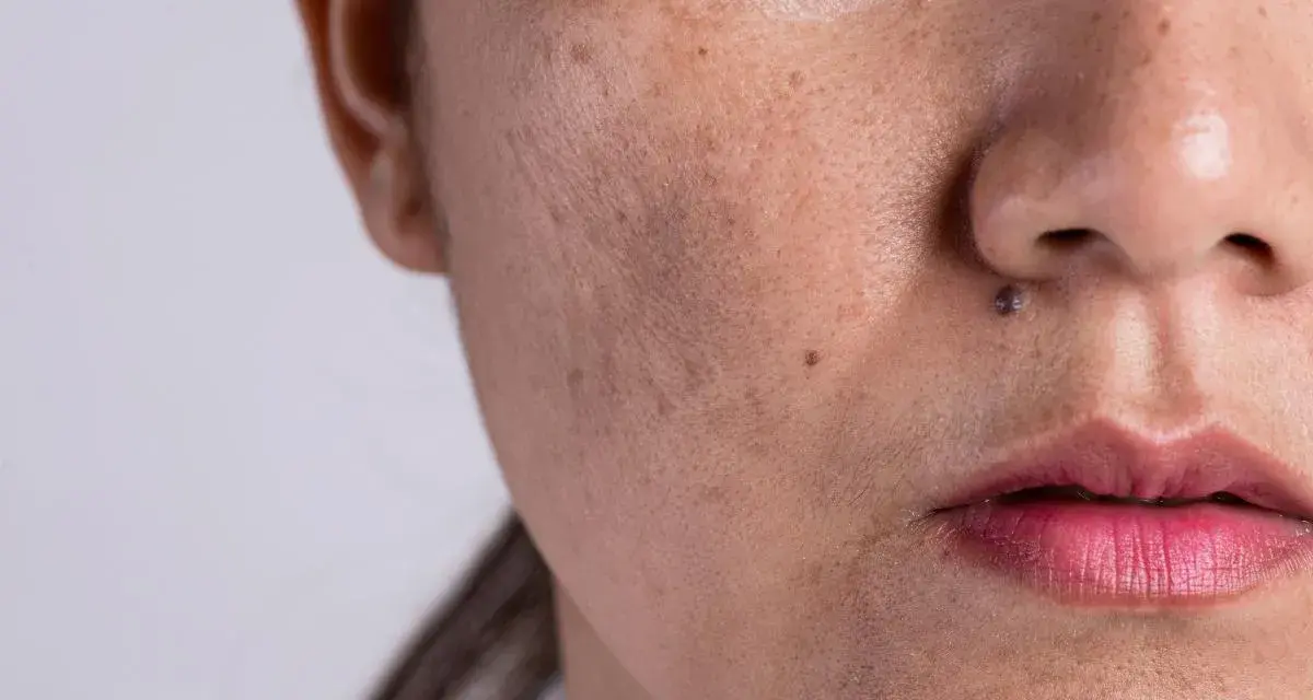 Primer plano de una cara con melasma y un pequeño lunar sobre el labio superior, simulando un bigote.
