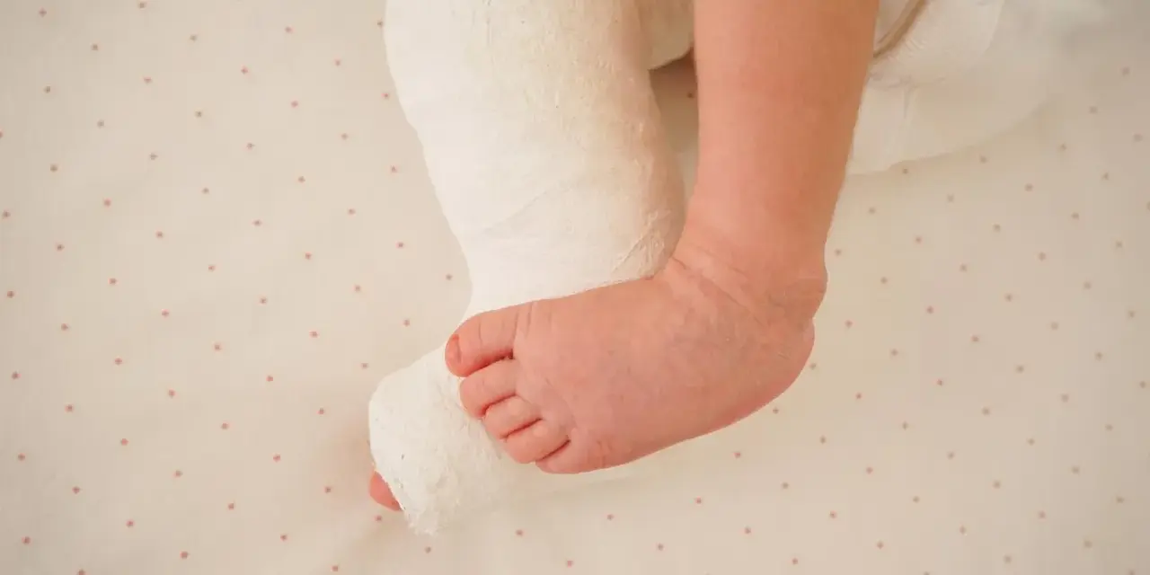 Noga dziecka w gipsie, z widoczną stopą. Leczenie końsko szpotawa u dorosłych wymaga cierpliwości, ale u maluchów rehabilitacja jest kluczowa.