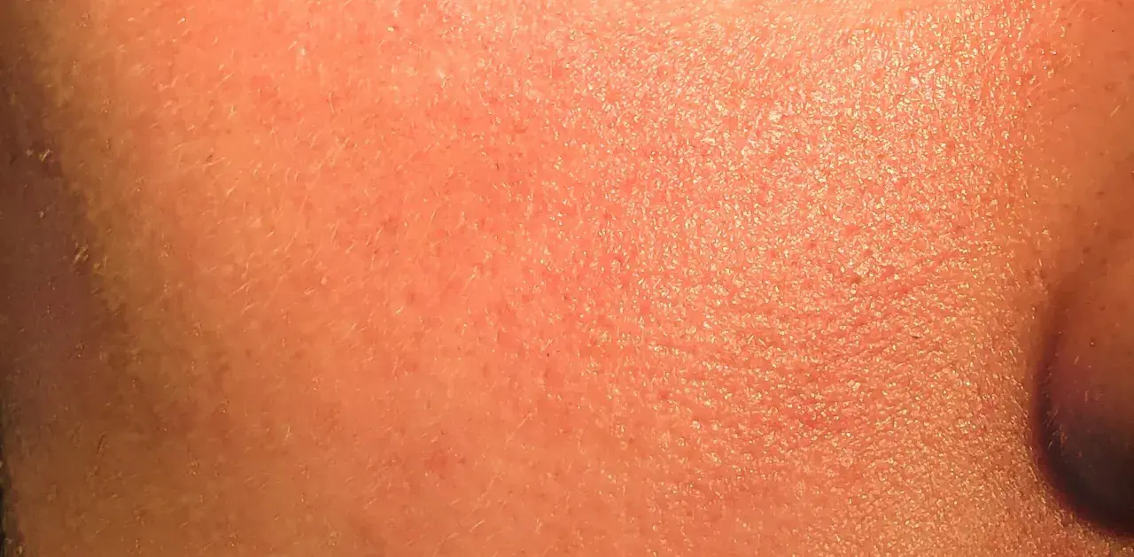 Pelle arrossata e secca, con piccole scaglie visibili, tipica di un'irritazione da retinolo.