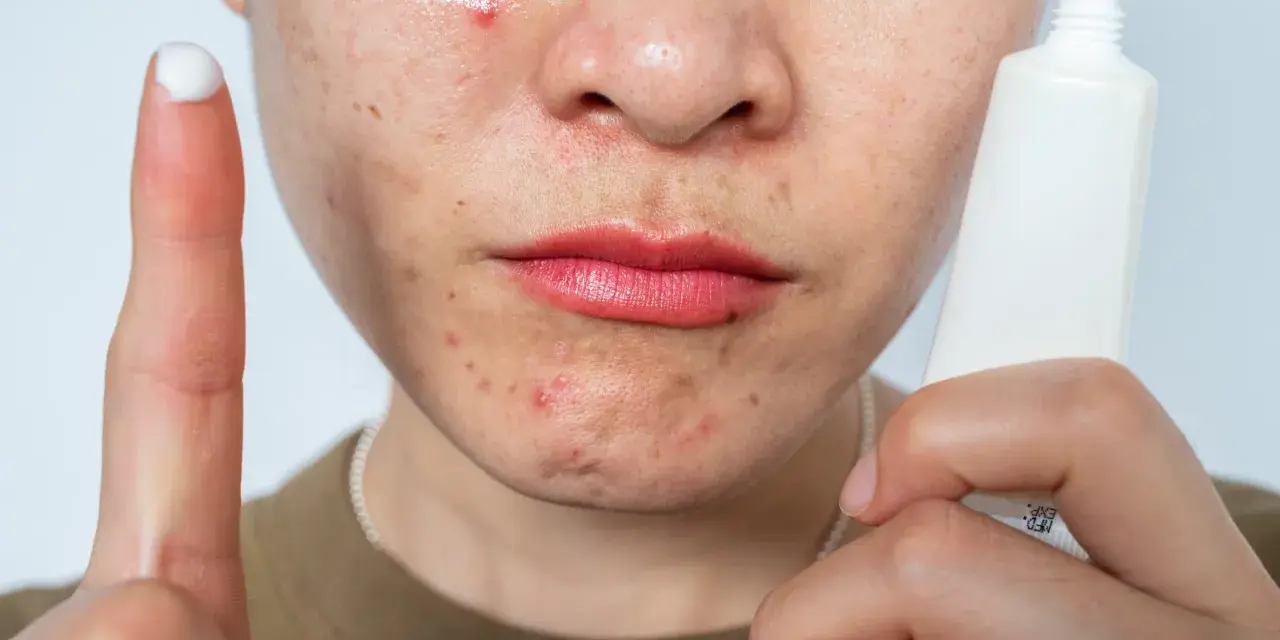 A person's face shows acne and redness, possibly from retinol burn. A finger with cream and a tube of skincare product are visible.