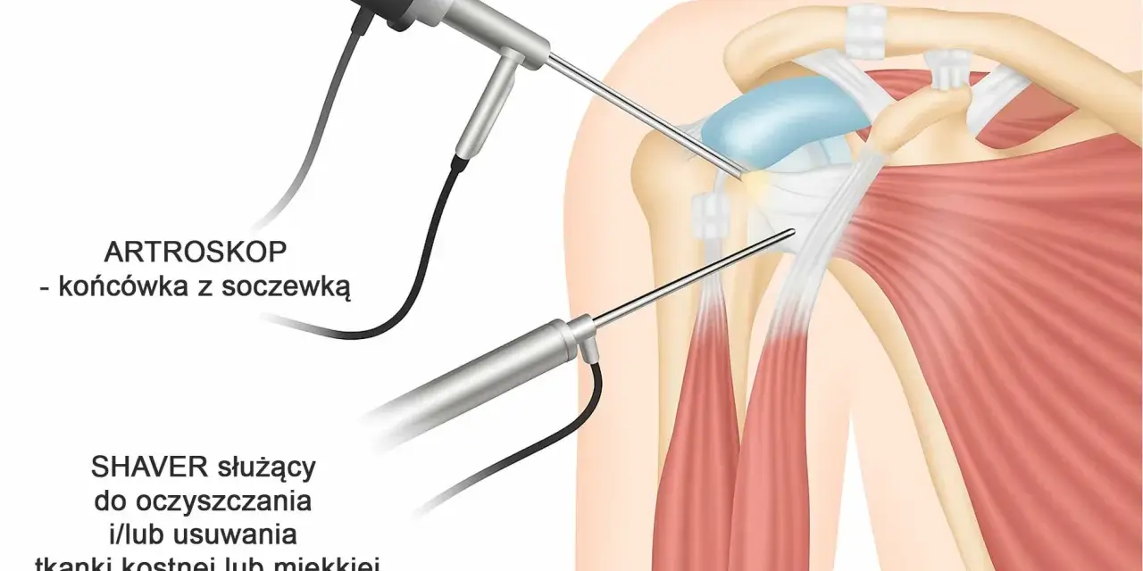 Artroskop i shaver w trakcie zabiegu barku, pomagające w diagnostyce i leczeniu bolesnego łuku.