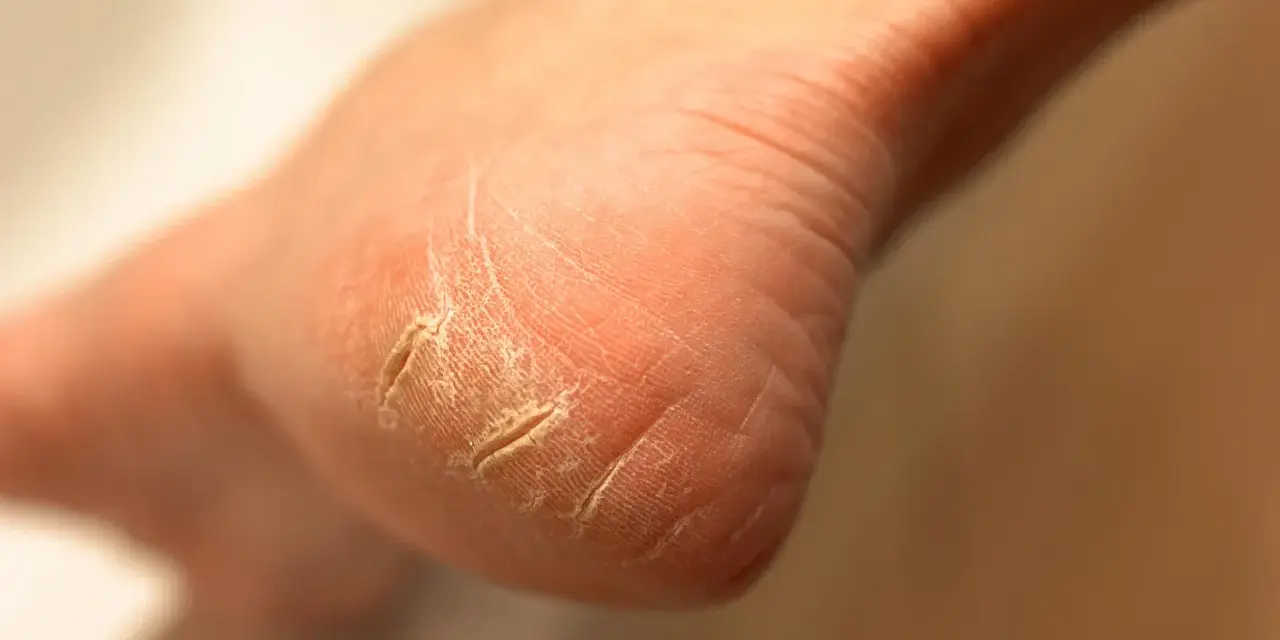 Gros plan sur un talon qui pele, la peau sèche et craquelée formant des sillons profonds.