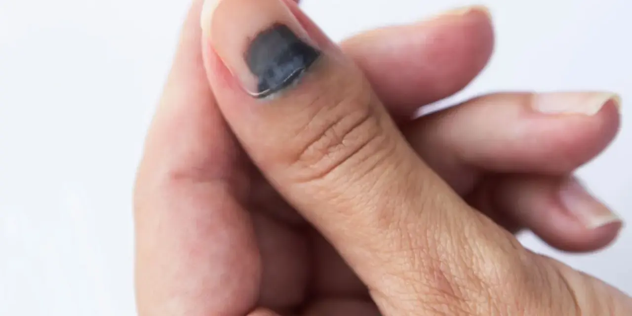 Gros orteil avec un hématome sous l'ongle, signe d'un traumatisme. La zone sombre indique le sang accumulé.