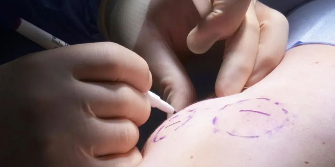 Chirurg markiert mit Stift die Stelle für die Lipomentfernung.