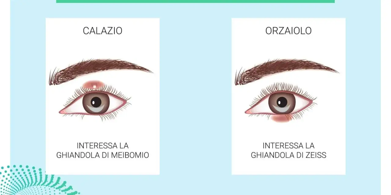 Illustrazione che confronta calazio e orzaiolo. Il calazio interessa la ghiandola di Meibomio, causando un gonfiore.