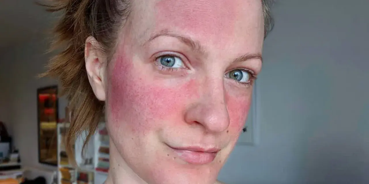 Frau mit stark geröteter Haut im Gesicht, möglicherweise Rosacea. Die Anwendung von Retinol kann hier eine Rolle spielen.