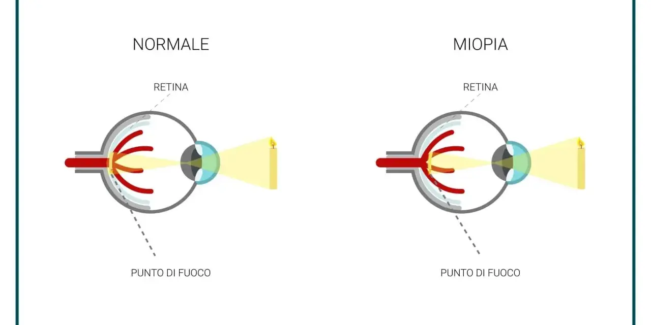 Confronto tra occhio normale e occhio miope: nella miopia, il punto di fuoco cade prima della retina, rendendo la visione sfocata.