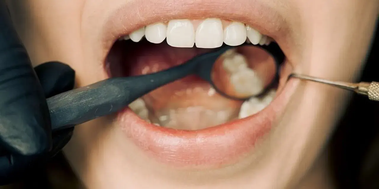 Dentysta bada ząb z plombą. Czy wiesz, plomba co to jest? To wypełnienie ubytku w zębie.
