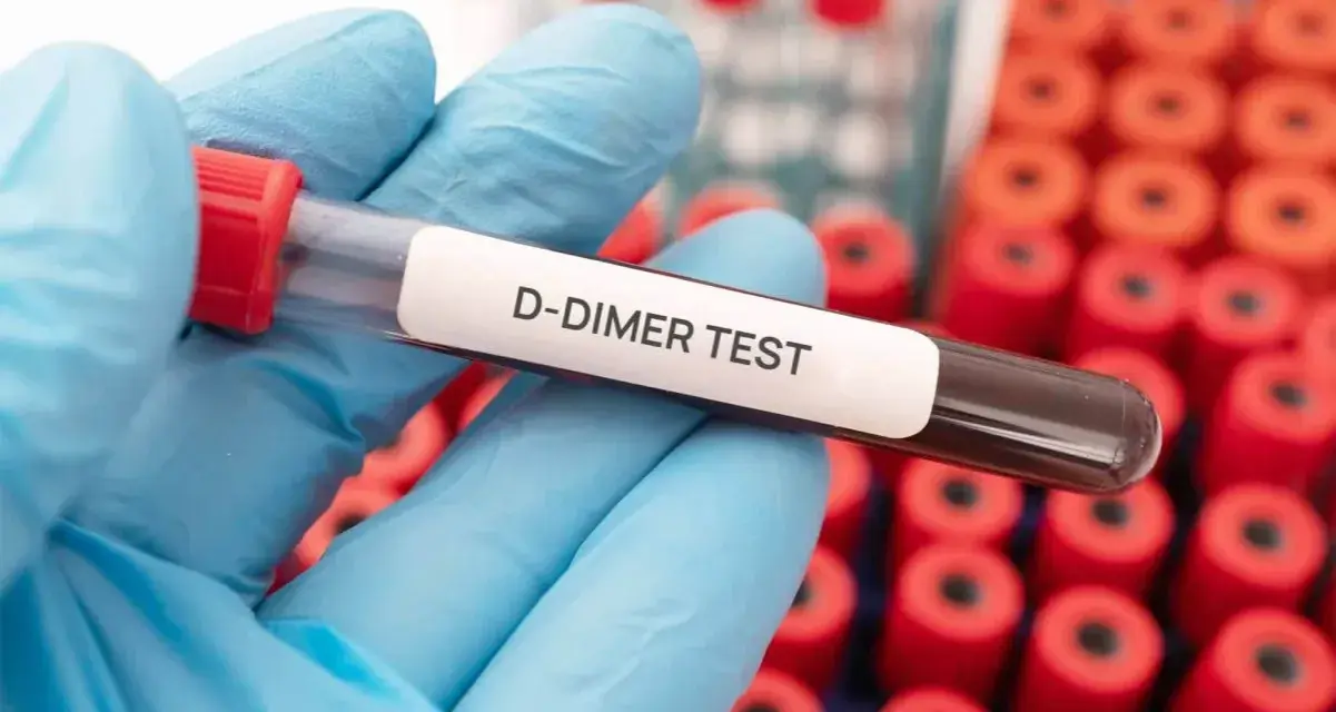 Rękawiczka trzyma probówkę z oznaczeniem "D-DIMER TEST". W tle widać wiele innych probówek. Podwyższone d-dimery mogą wskazywać na zakrzepicę.