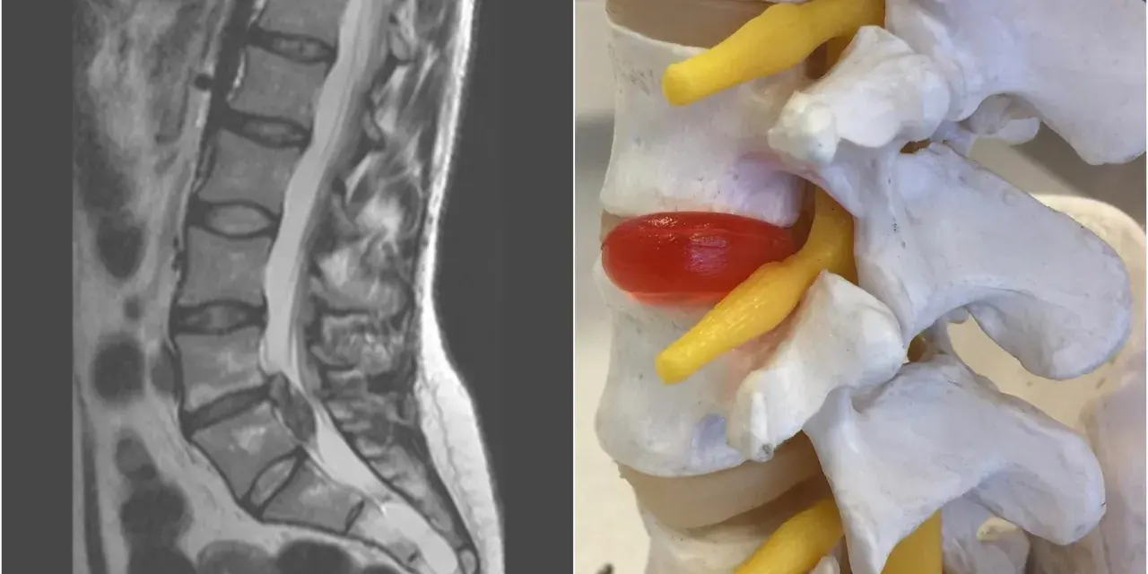 MRI kręgosłupa lędźwiowego i model anatomiczny ukazują ucisk na worek oponowy, który może powodować objawy neurologiczne.