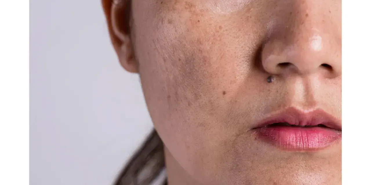 Nahaufnahme eines Gesichts mit sichtbarem Melasma über der Oberlippe und dunklen Flecken.