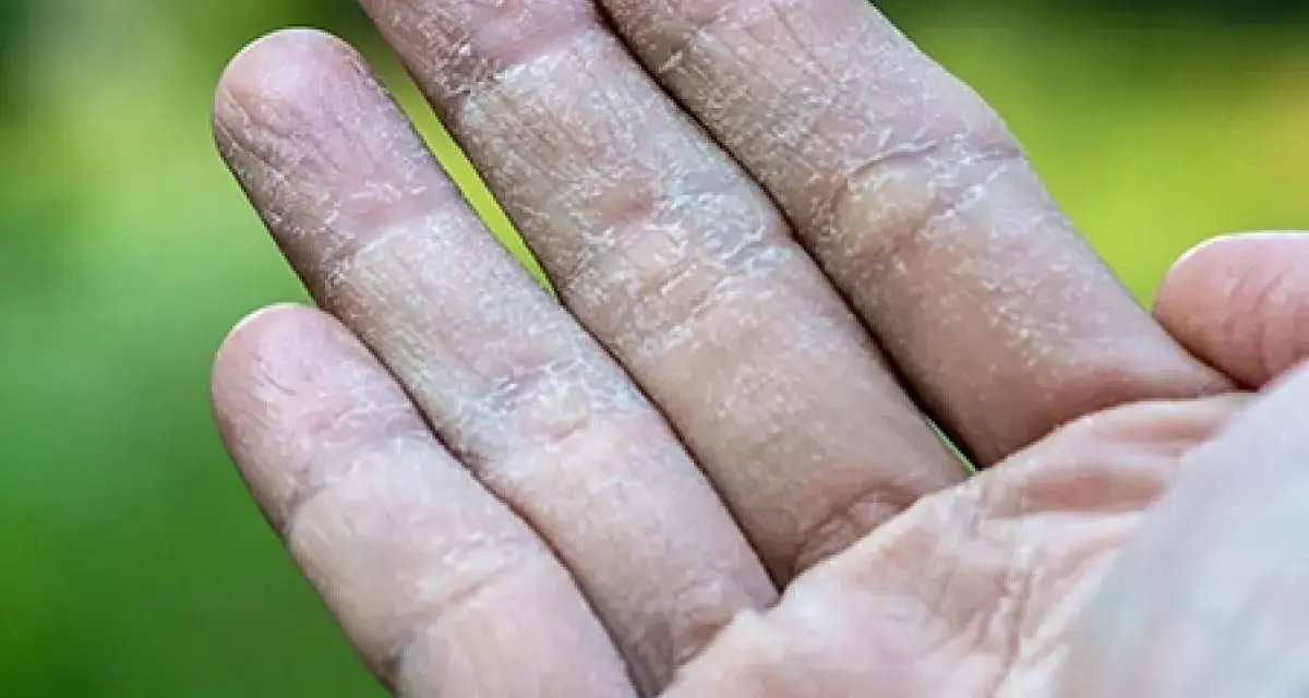 Dedos con piel seca y escamosa, similar a ampollas en los pies por sudor.
