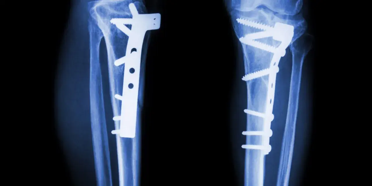 RTG kolan po zabiegu osteotomii guzowatości kości piszczelowej. Widoczne zespolenia płytami i śrubami.