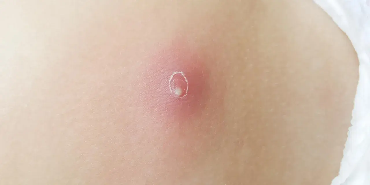 Rote, entzündete Haut mit einem kleinen, weißen Eiterkopf in der Mitte. So sieht ein Abszess aus, wenn er sich bildet.