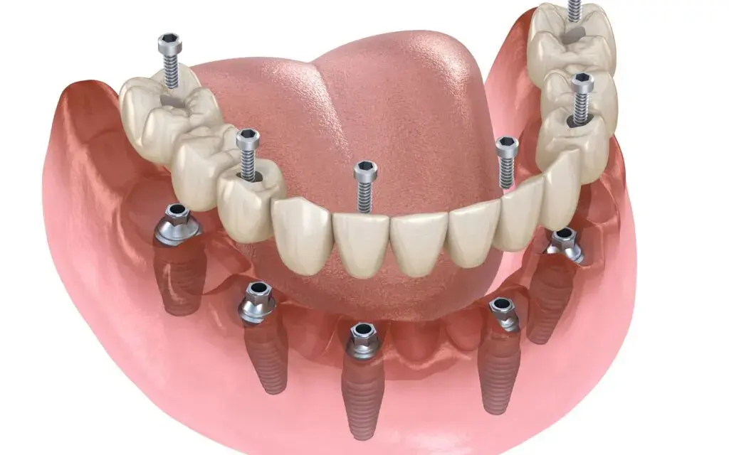 Ile kosztuje implant zęba? Pełny cennik i jak mądrze zaplanować budżet