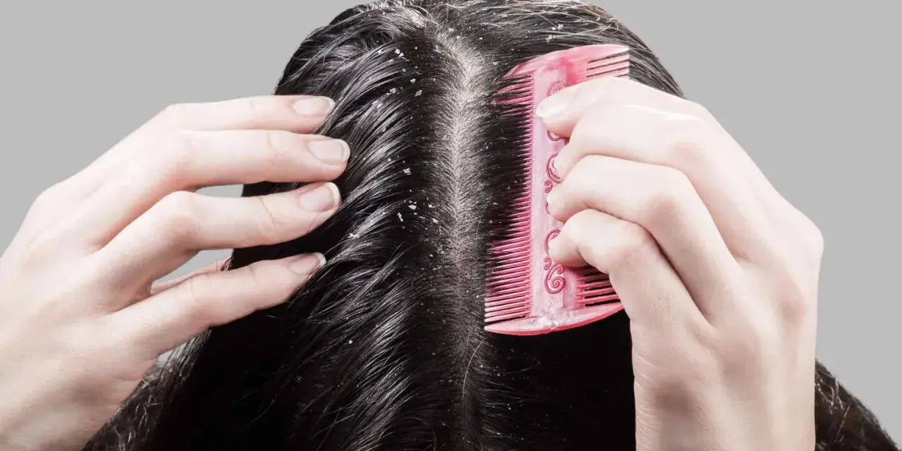Hände kämmen dunkles Haar, das sichtbare Schuppen zeigt. Die trockene Kopfhaut ist deutlich zu erkennen.