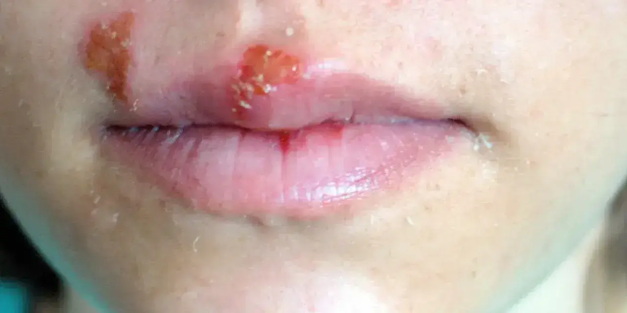 Obrzęknięte usta z widocznymi pęcherzykami i strupkami, objawy opryszczki.