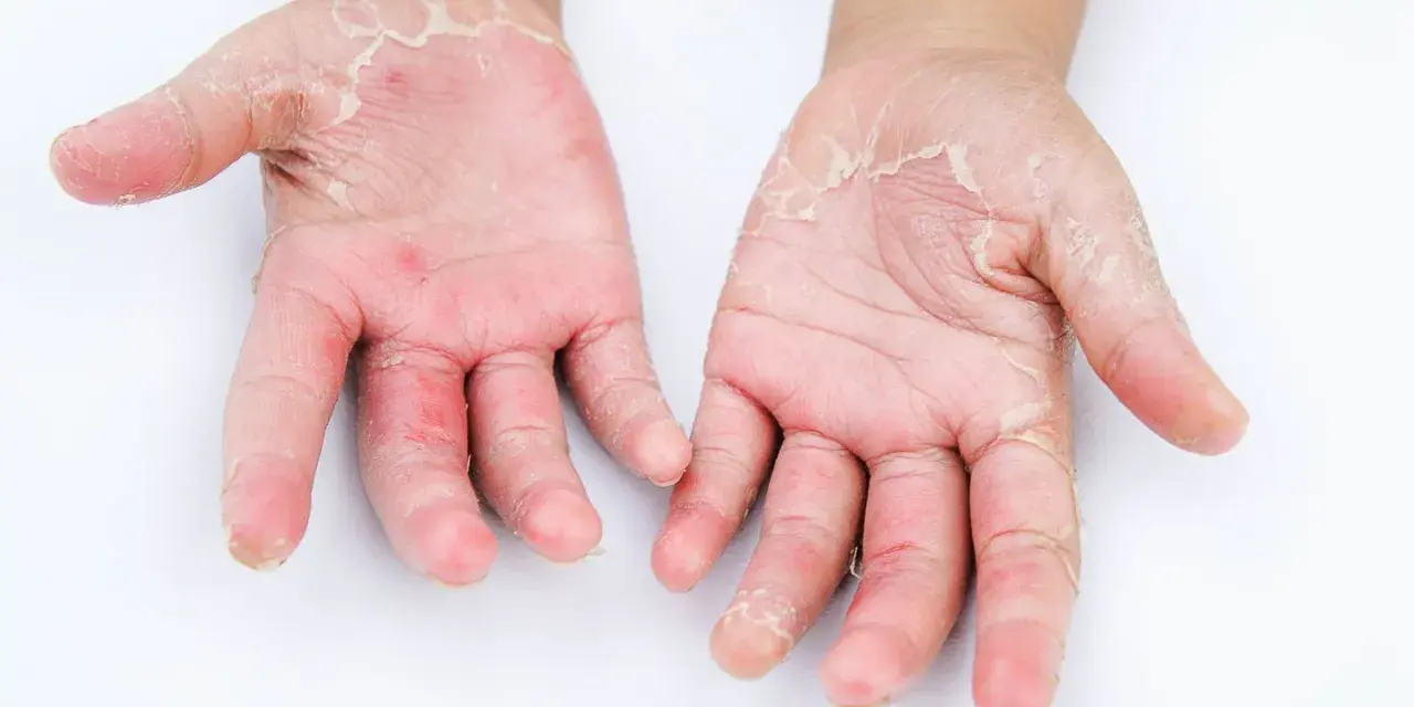 Mani con evidente desquamazione della pelle, arrossamento e secchezza. La pelle appare irritata e screpolata.