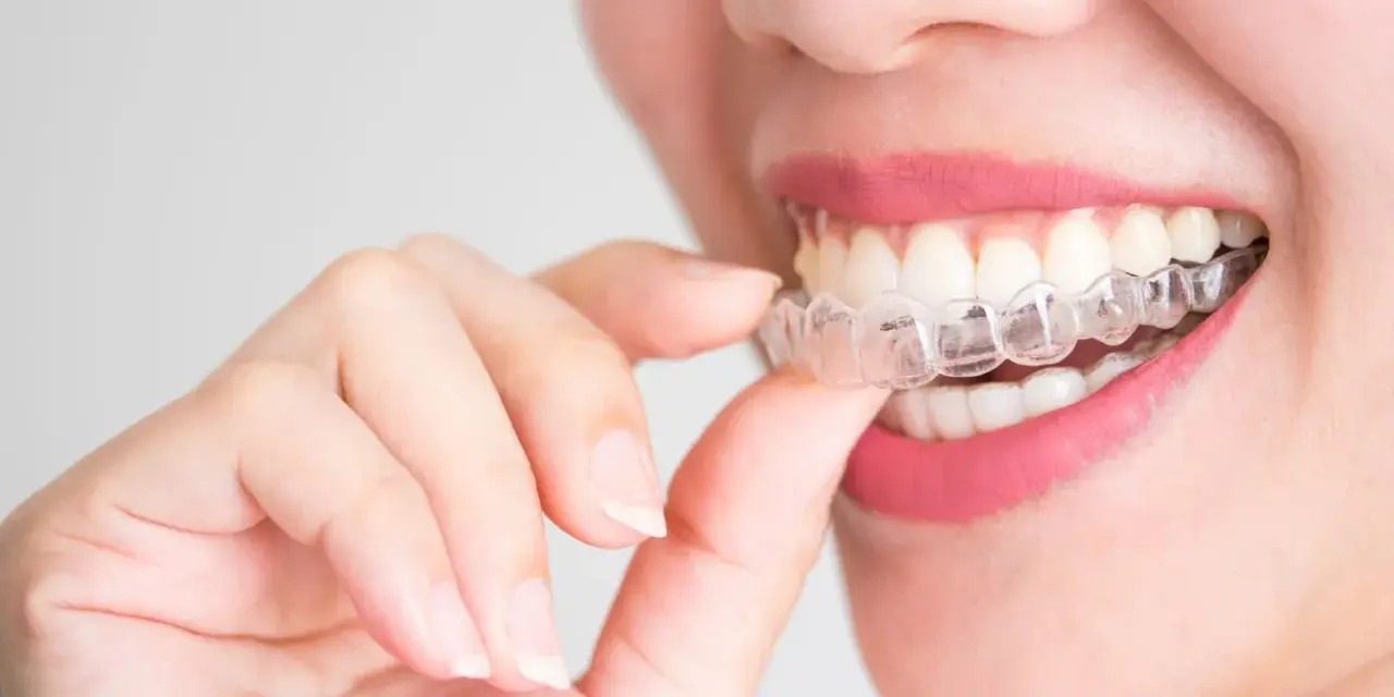 Kobieta z różowymi ustami zakłada przezroczysty aparat Invisalign na zęby.