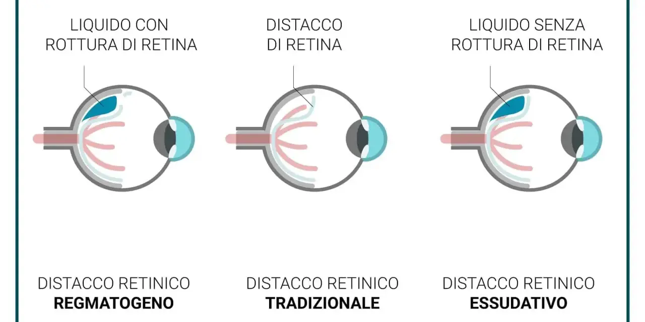 Illustrazione mostra tre tipi di distacco della retina: con rottura, tradizionale e essudativo. Il buco nella retina è evidenziato in uno dei casi.