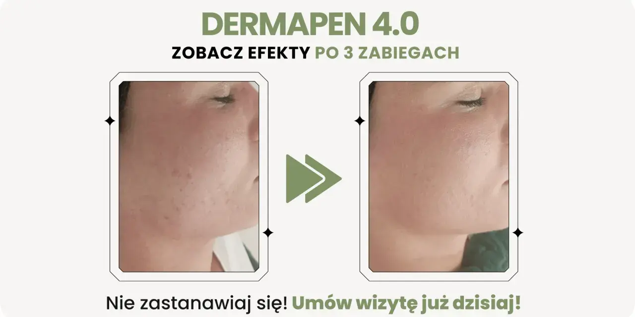 Dermapen 4.0 na co? Zobacz efekty po 3 zabiegach: skóra wygładzona, bez niedoskonałości. Umów wizytę!