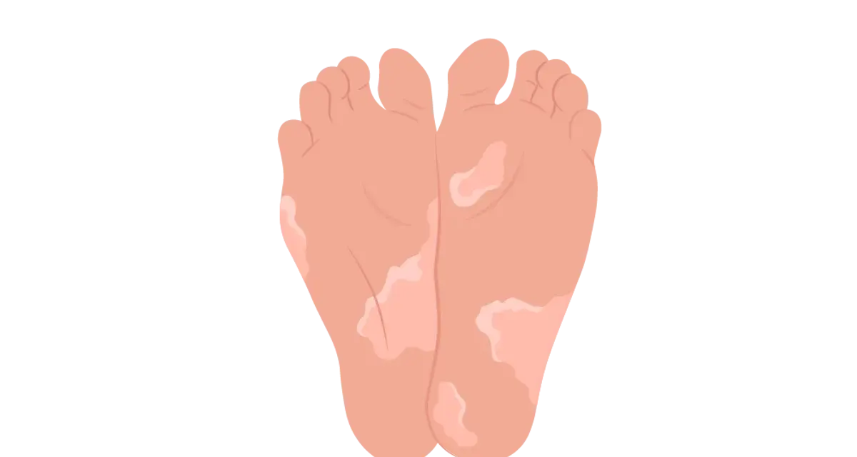 Pieds avec des zones dépigmentées, soulevant la question : pourquoi la peau de mes pieds s'enlève ?