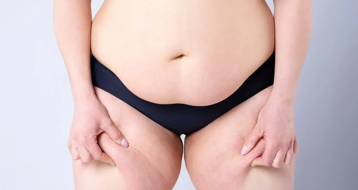 Persona se pellizca la piel de los muslos, mostrando la celulitis. Pensando en ejercicios abdomen bajo para mejorar.
