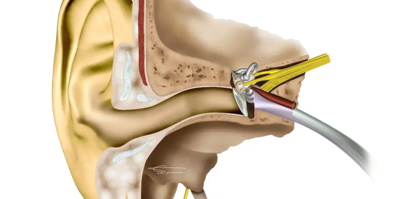 Coupe anatomique de l'oreille montrant les structures internes, y compris le tympan et les osselets, qui peuvent être affectés par une distorsion sonore oreille.